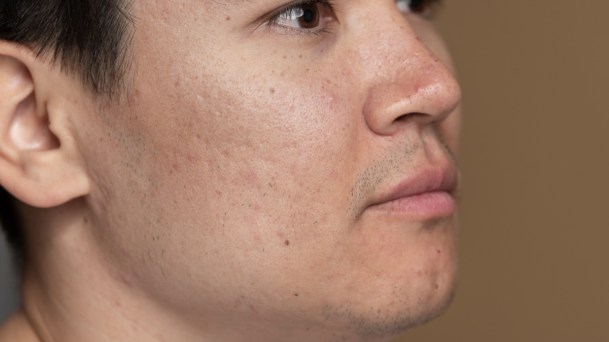 Open Pores Treatment at Home: Natural Ways to Minimise Pores