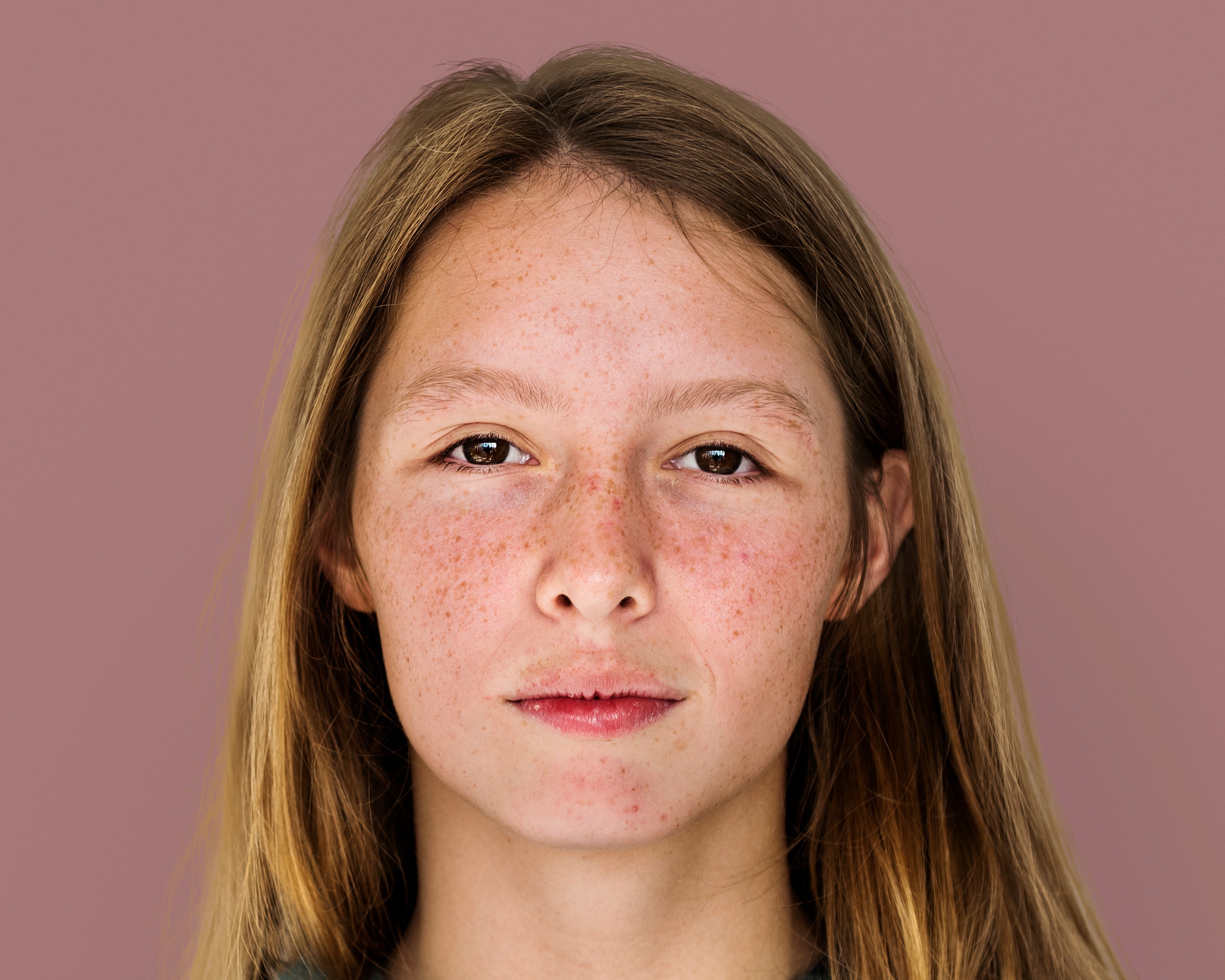 how to remove dark pigmentation on face