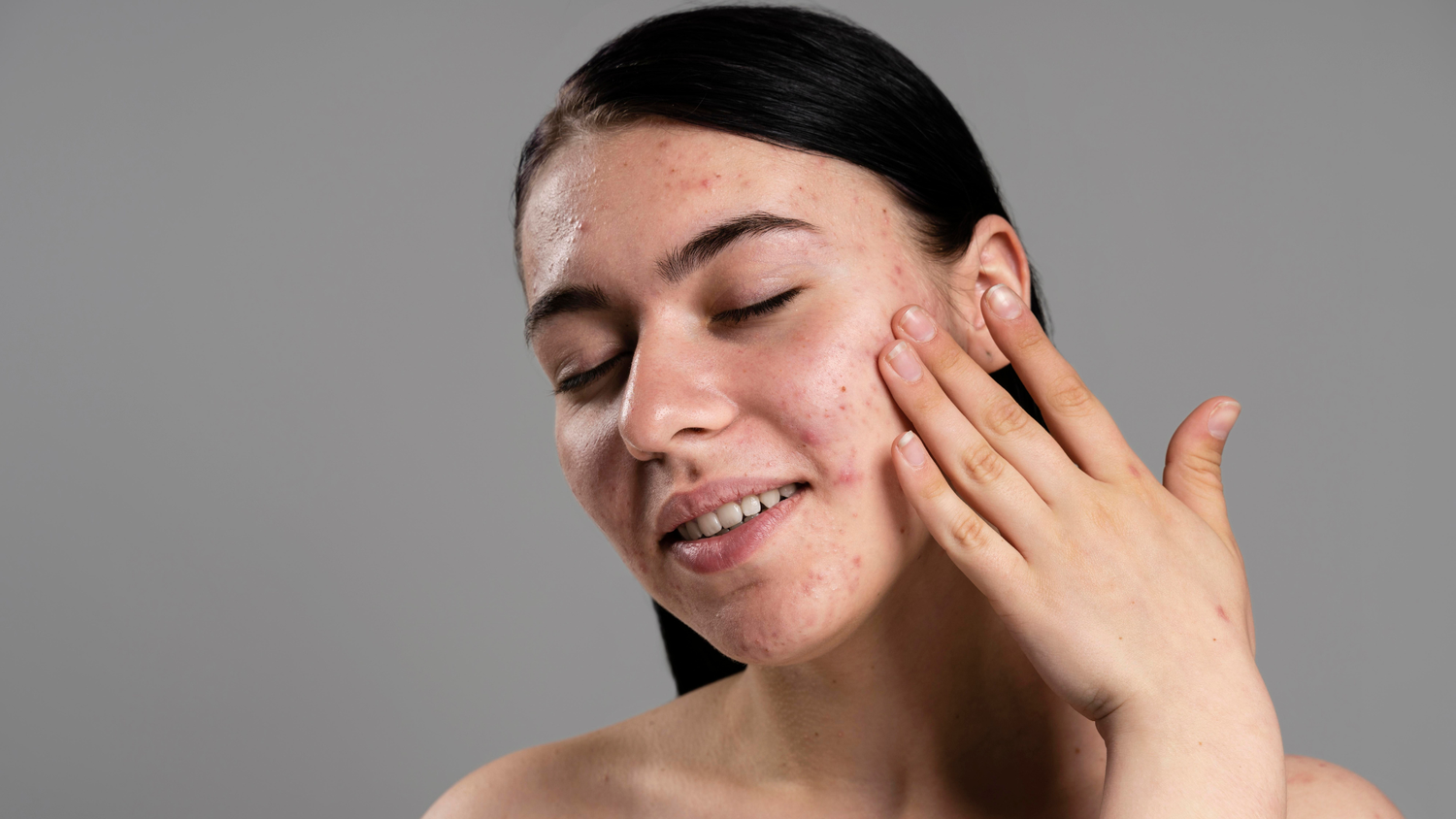 how to reduce acne redness