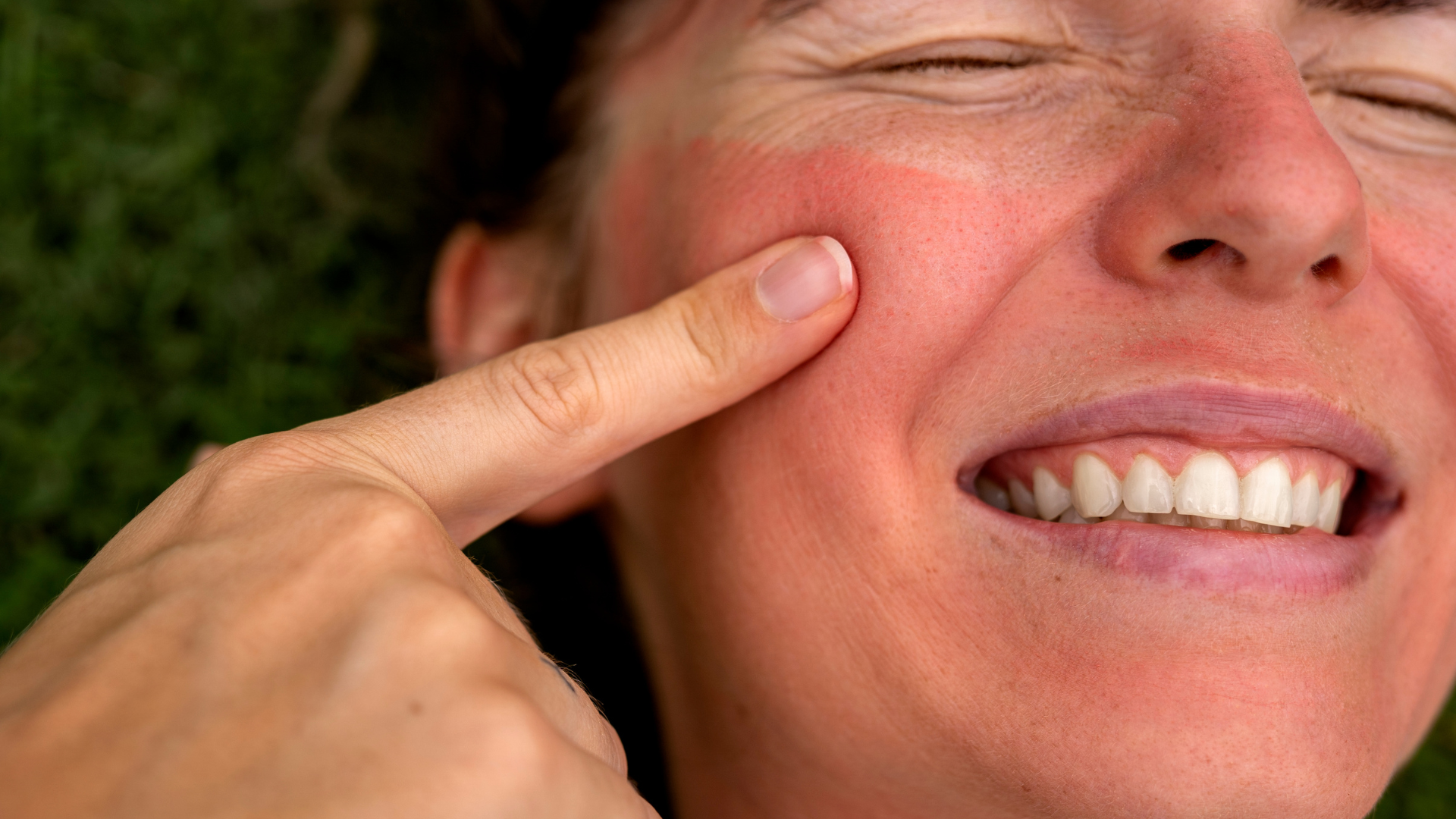 sunburn treatment for face