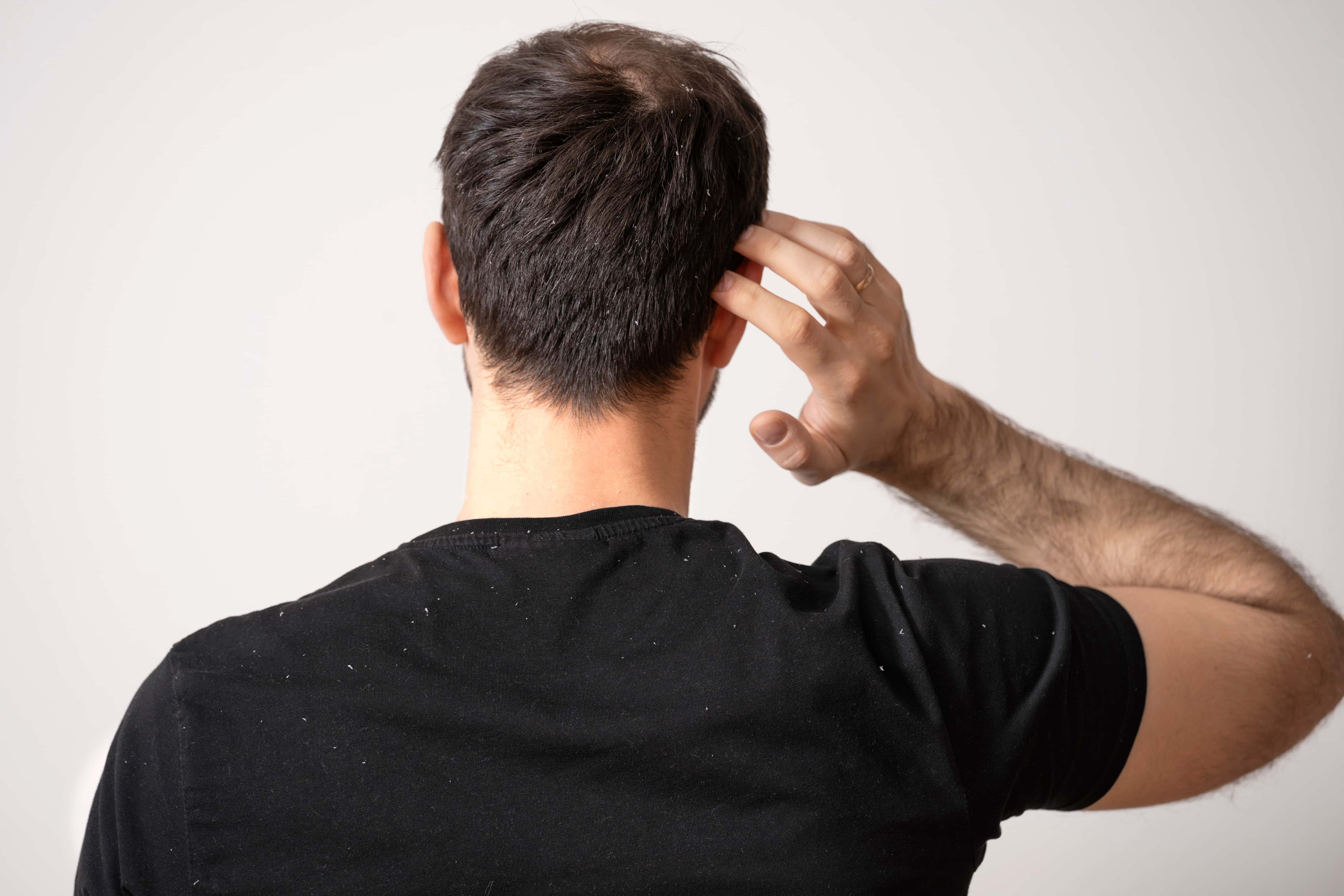 dandruff vs dry scalp